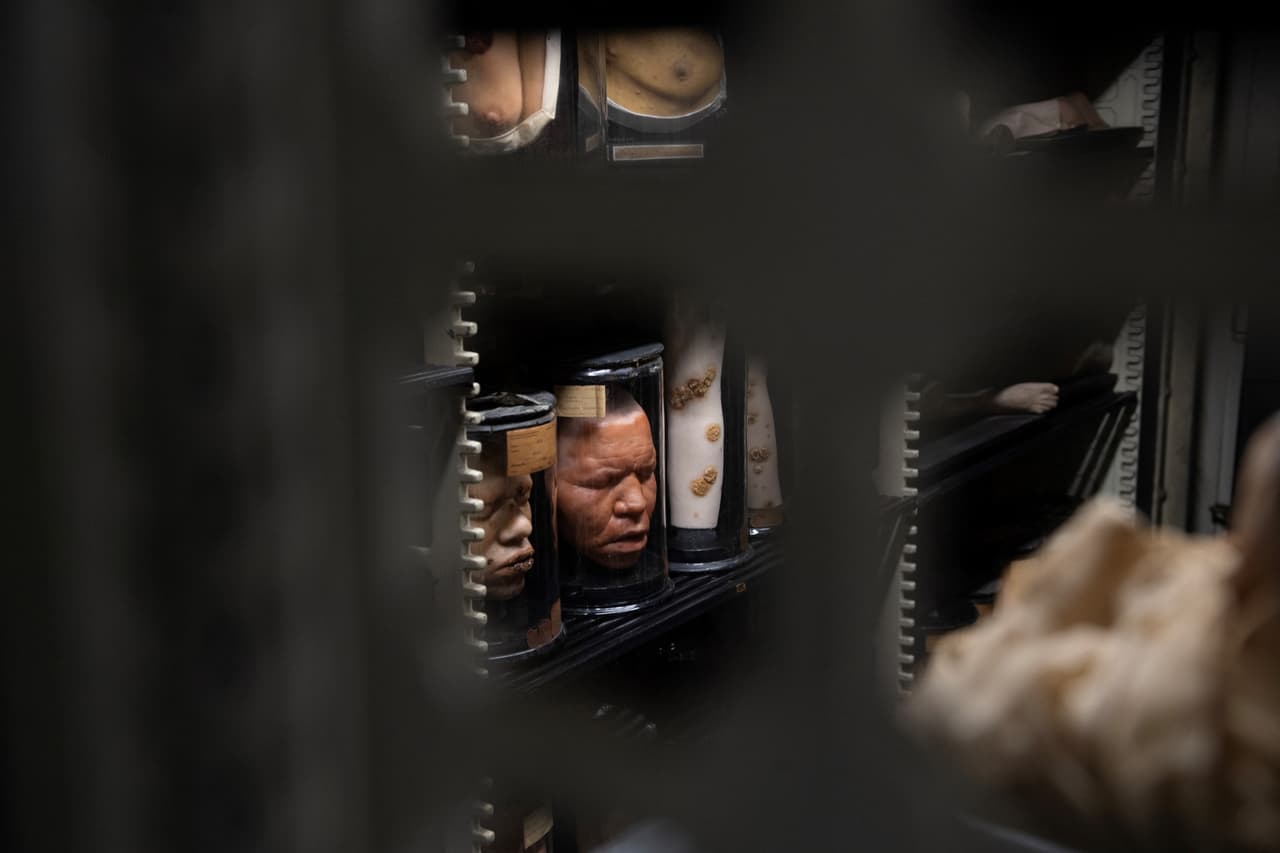 Una activista apunta al esqueleto anónimo de 2.29 metros: “Debe exhibirse con respeto y ayudar a comprender la acromegalia”.
<br>
<br>El molde de cera del rostro de un hombre con lepra.