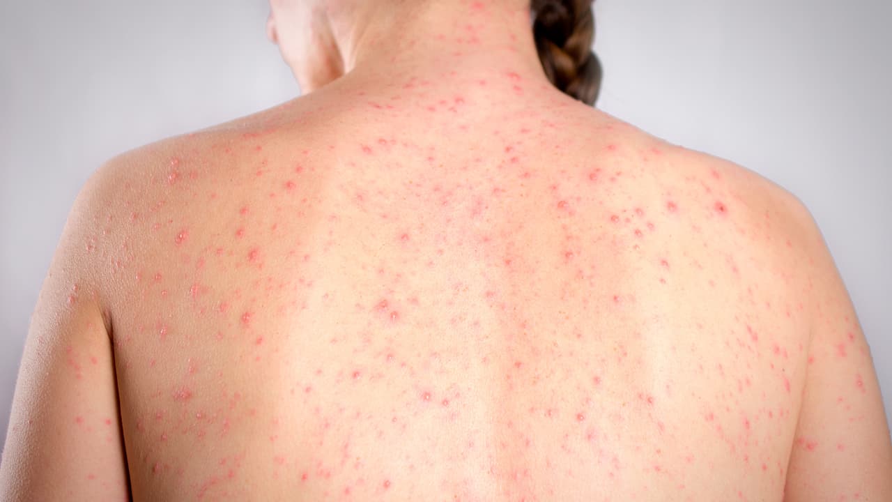 Alertan por posible exposición al sarampión en el condado de Maricopa