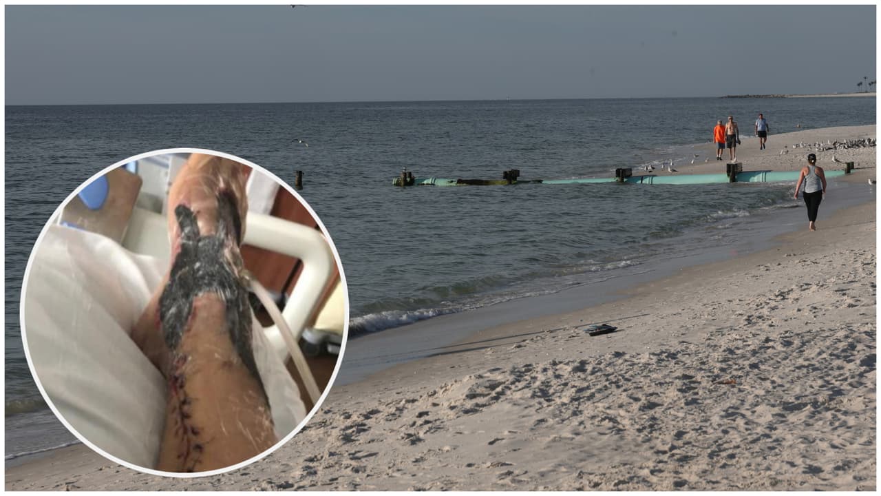 Al menos cuatro personas han muerto en Florida en el 2025 por la bacteria come carne