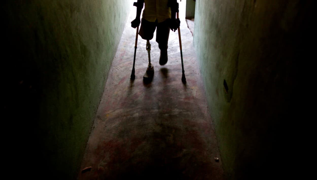 Electricista demanda por la cirugía en su rodilla que terminó en una amputación en California