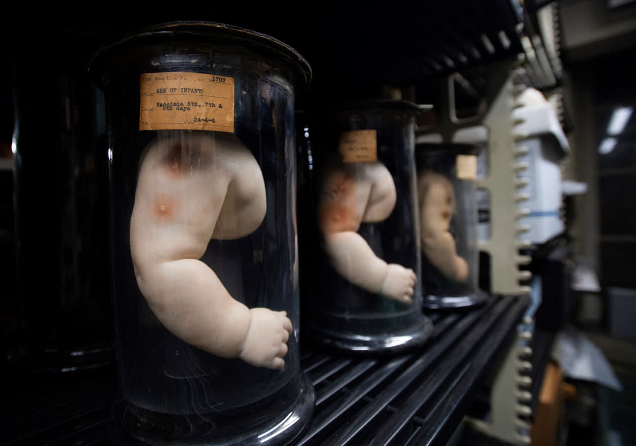 Moldes de cera de brazos recibiendo una vacuna.
<br>
<br>Incluso el paciente que había donado su corazón intentó recuperarlo en medio de la controversia.
<br>