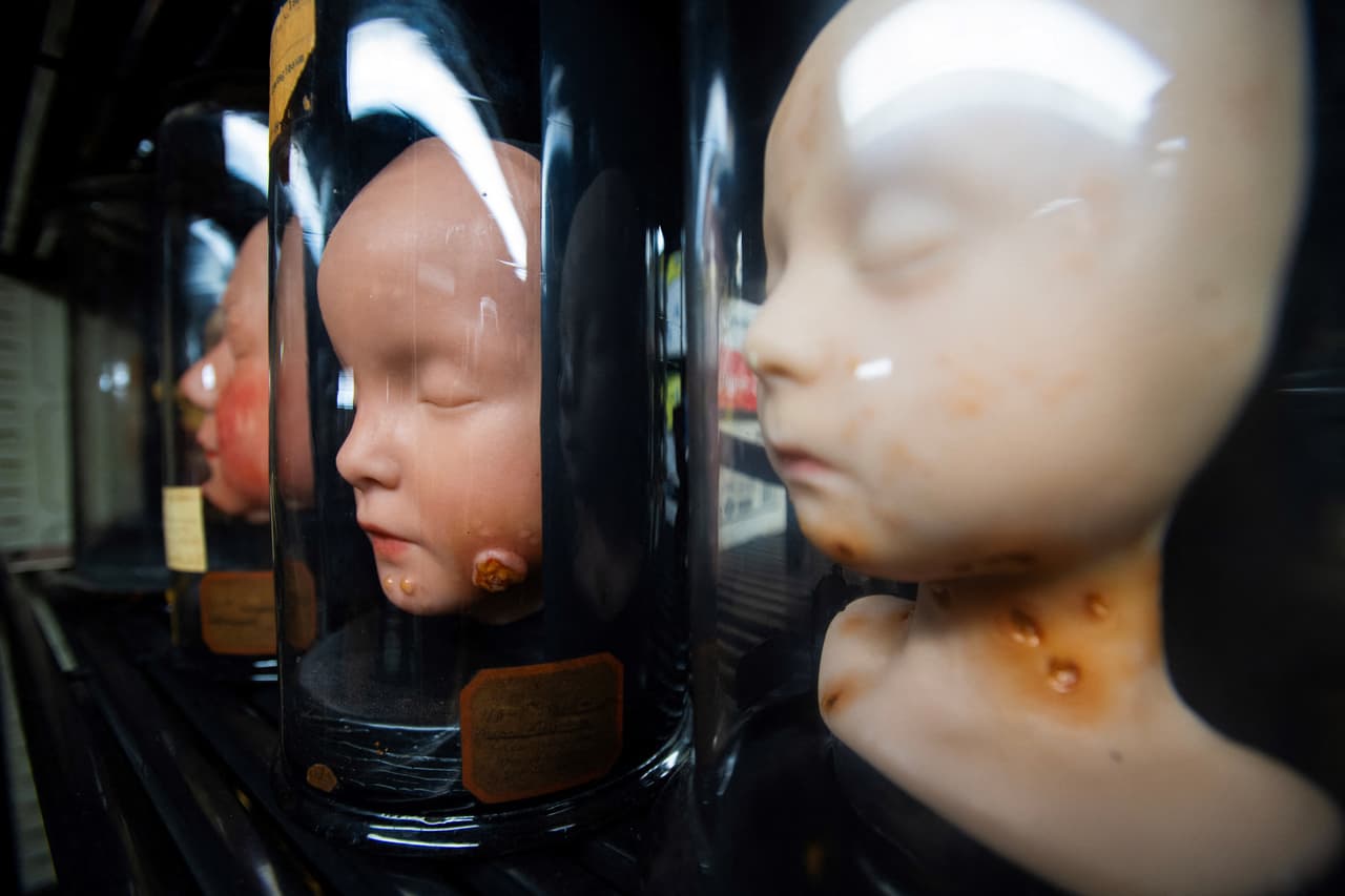 Como parte del proceso, el museo borró cientos de videos de su canal de YouTube, con más de 100,000 seguidores. “Ahí fue cuando empezó la polémica”, recuerda Kate Quinn, quien hasta abril de este año fue la directora del museo.
<br>
<br>Moldes de cera que muestran distintas afecciones faciales en niños.