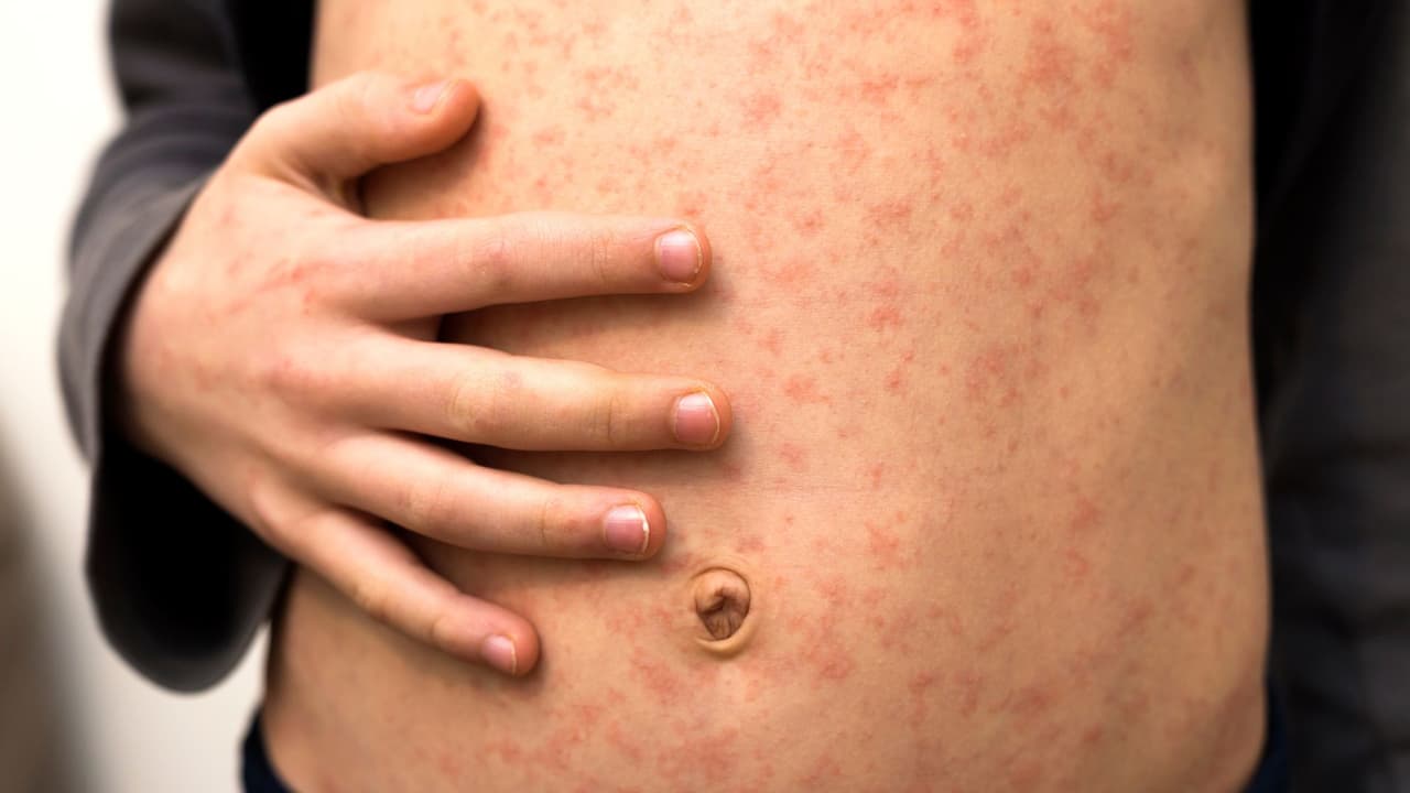 Una escuela en área de San Antonio reporta un caso de rubéola, pero autoridades texanas lo niegan