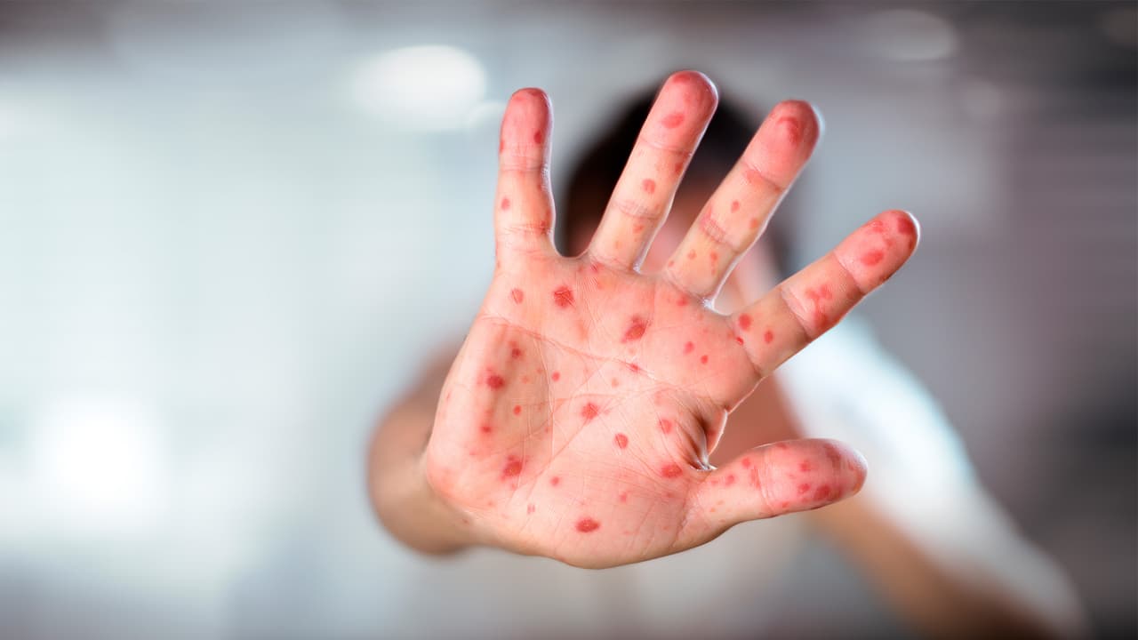 Identifican dos nuevos casos de sarampión en el Condado de Maricopa; alertan por exposición