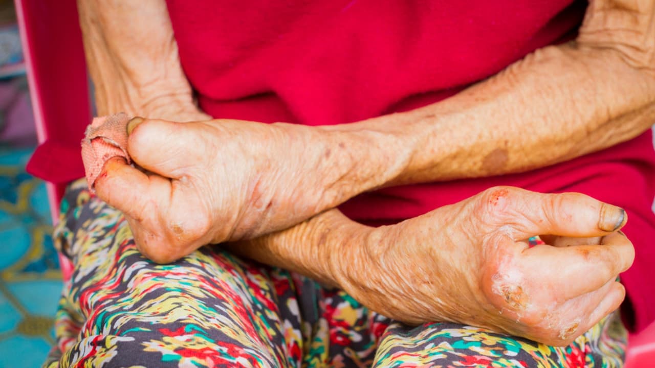 Manchas en la piel, sensibilidad y otras señales de alerta de la lepra