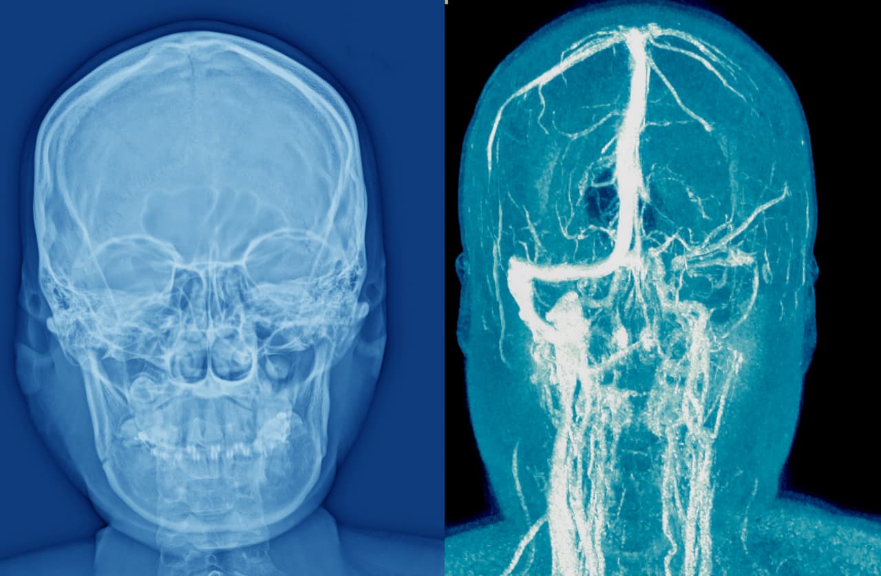 <h3 class="cms-H3-H3">7. Efectos tardíos de enfermedad cerebrovascular</h3>
<br>
<br>🏥
<b>Crecimiento en costo por caso de acuerdo con el Índice de Gastos Médicos: </b>4.95
<br>
<br>🏥
<b>Aumento del gasto en los últimos 10 años registrados: </b>189.4%