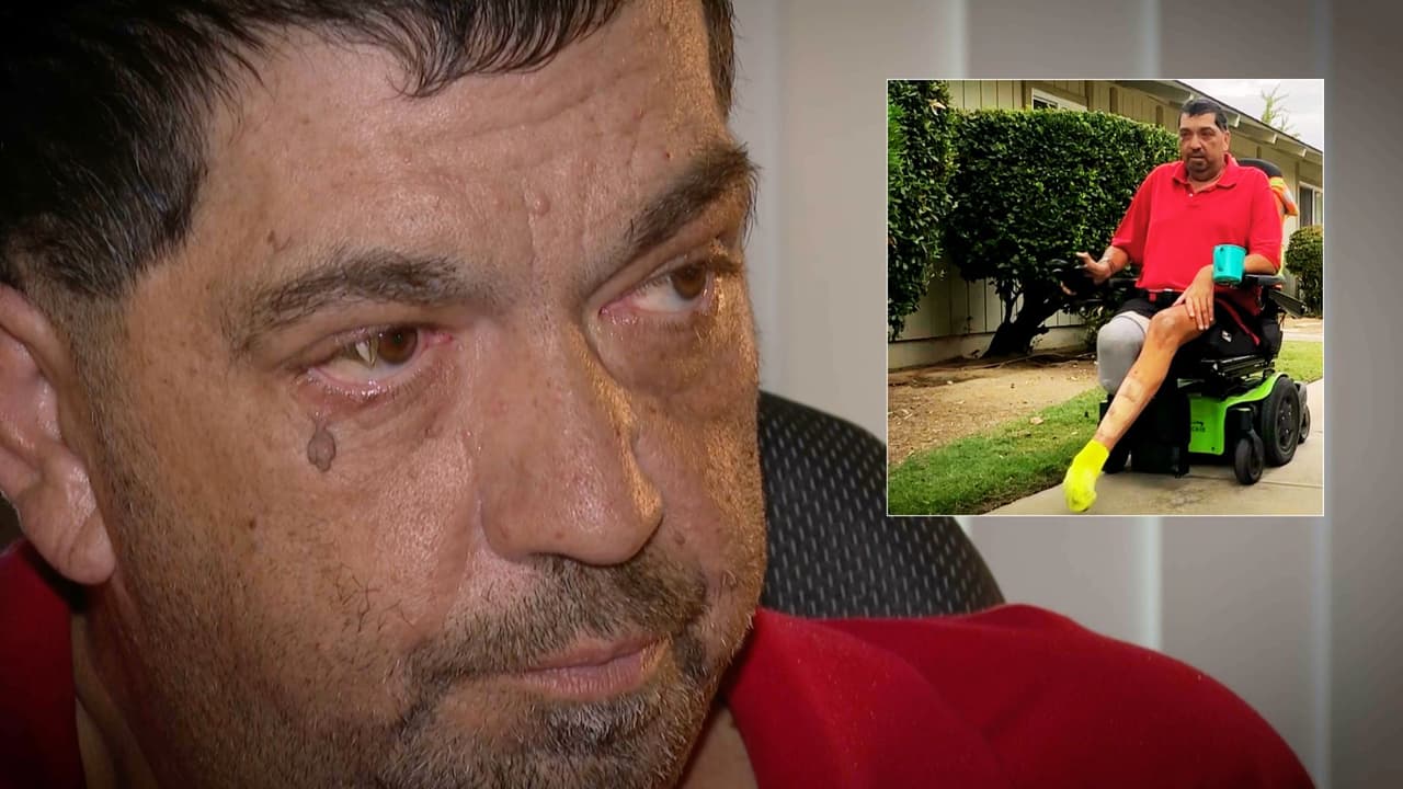 "Yo no sabía": hispano despierta en el hospital con una pierna amputada y diagnóstico de diabetes