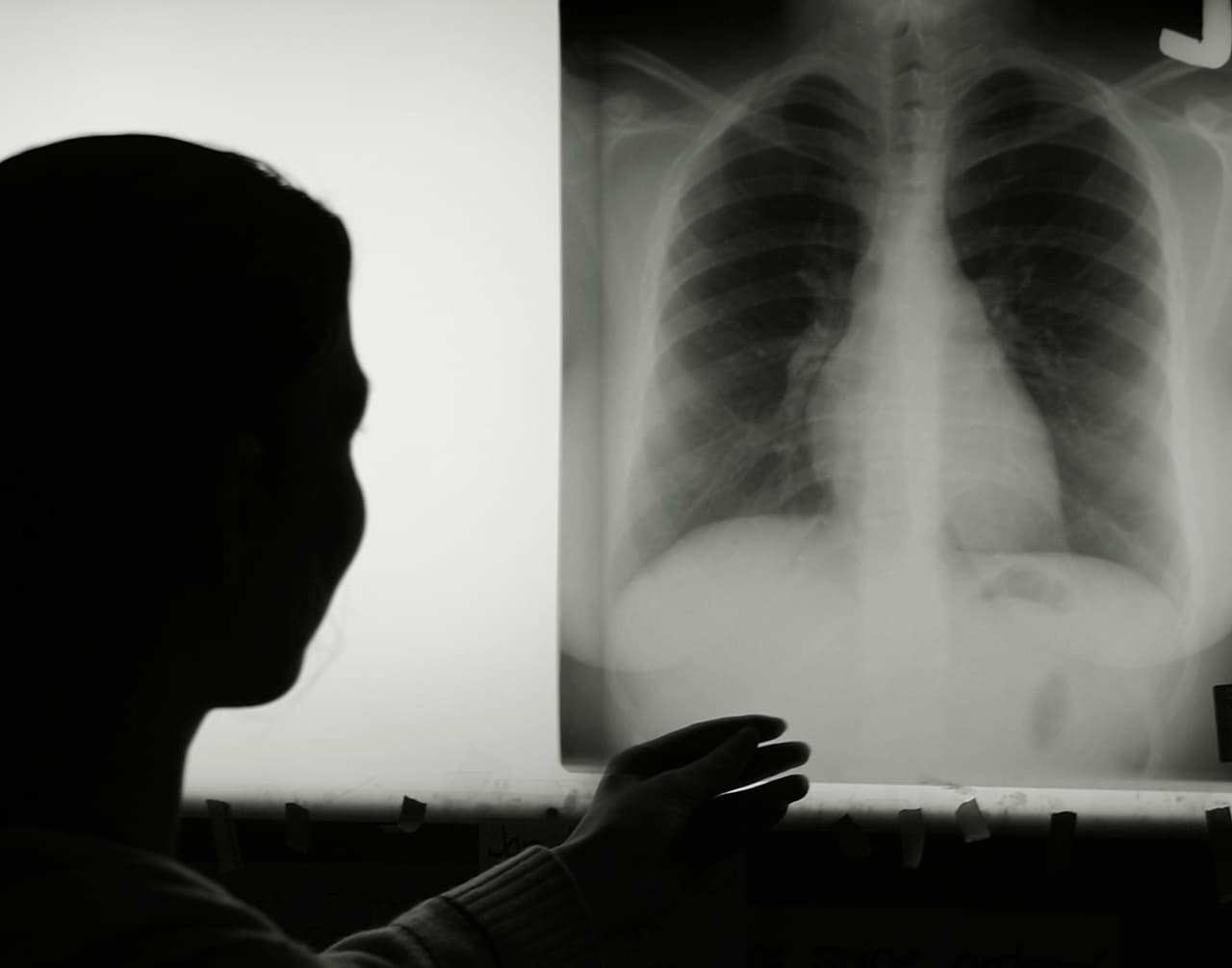 Cáncer de pulmón, más letal entre las mujeres