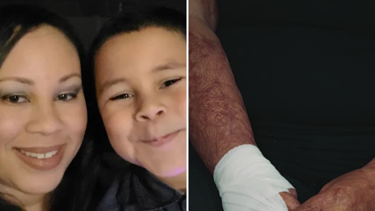 “Nunca había sentido tanto dolor”: la batalla legal de hispana atacada con fuego por su ex