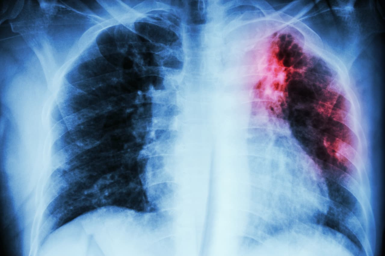 <h3 class="cms-H3-H3">23. Tuberculosis</h3>
<br>
<br>🏥
<b>Crecimiento en costo por caso de acuerdo con el Índice de Gastos Médicos: </b>3.38
<br>
<br>🏥
<b>Aumento del gasto en los últimos 10 años registrados: </b>108.9%
<br>
