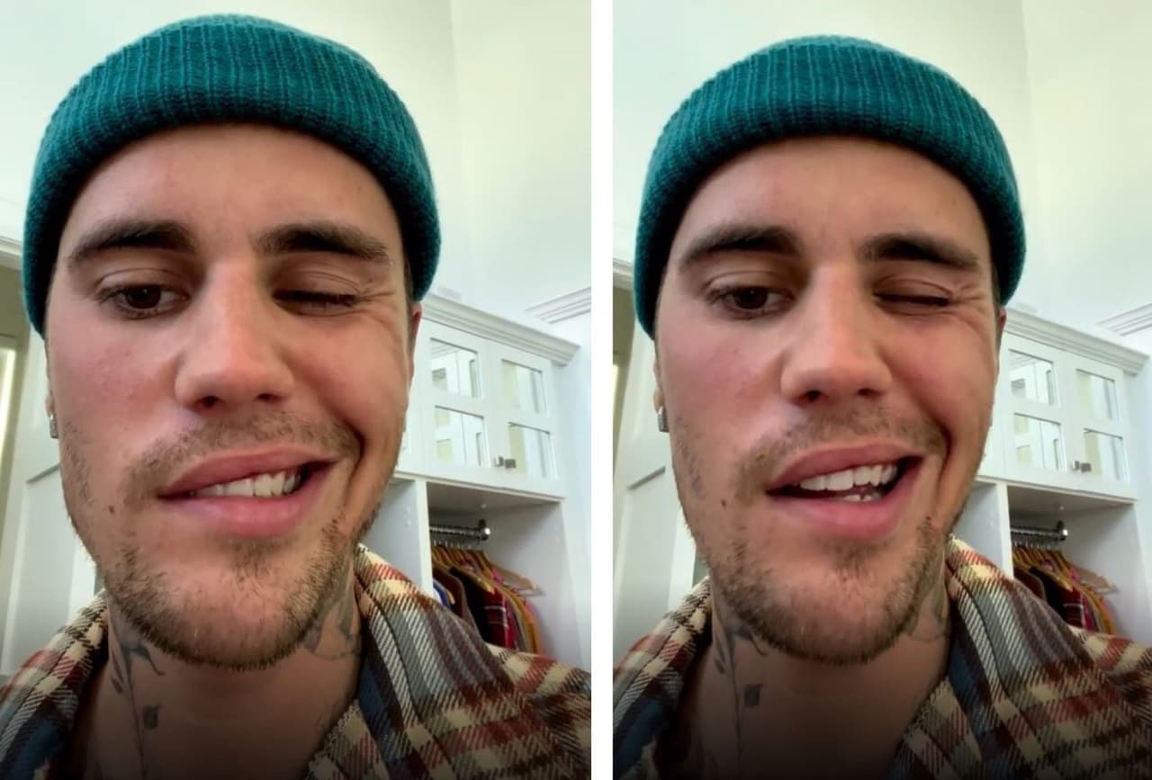 Bieber compartió su estado de salud en un video en Instagram en donde mostró cómo el lado derecho de su cara permanece totalmente inmóvil. “Como pueden ver, este ojo no está parpadeando. No puedo sonreír de este lado de mi cara; esta fosa nasal no se moverá. Así que hay una parálisis total en este lado de mi cara”, expresó.