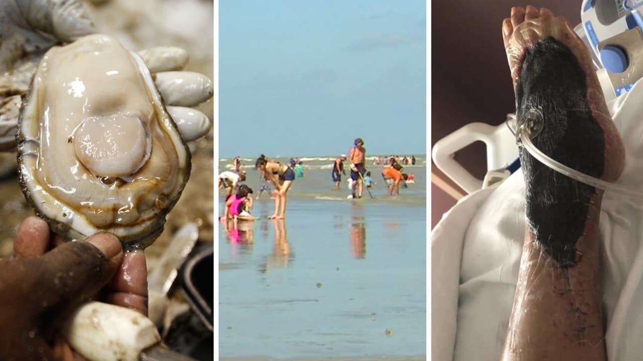 Esto le hace al cuerpo la bacteria ‘comecarne’ cuando se contrae al comer mariscos crudos