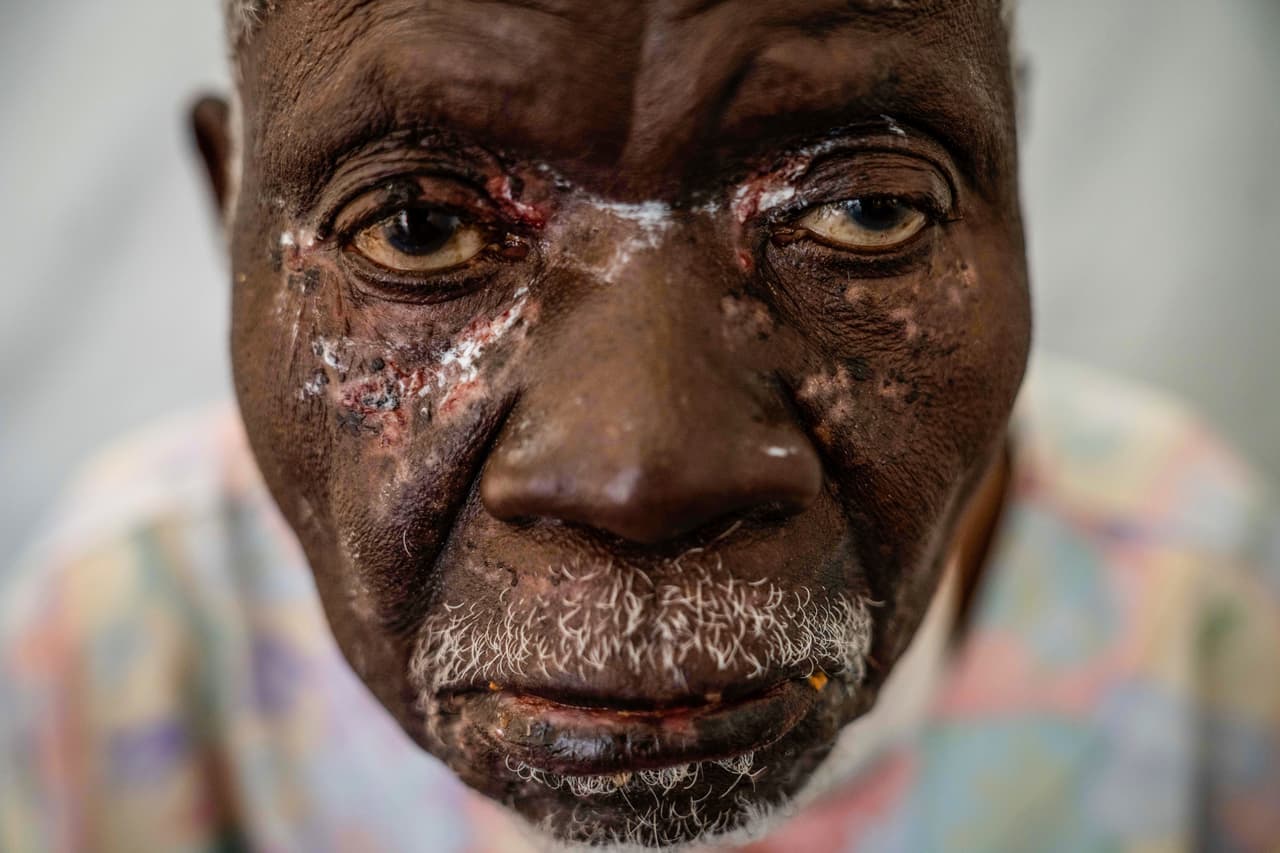 Christophe Chavilinga, de 90 años, contagiado de 'mpox', viruela símica en Munigi, Congo. Es una enfermedad viral que pertenece a la misma familia de la viruela. Es endémica en partes de África, donde la gente se infecta por mordeduras de roedores. Los síntomas van desde fiebres y dolores hasta lesiones en rostro, manos y genitales. En 2024 se detectó la aparición de una
<a href="https://www.univision.com/noticias/salud/que-se-sabe-sobre-el-caso-del-nuevo-tipo-de-viruela-simica-o-mpox-registrado-en-california-eeuu">nueva forma de viruela símica que se transmite por contacto,</a> incluido el contacto sexual, lo que llevó a la OMS a declarar una emergencia de salud mundial en agosto.