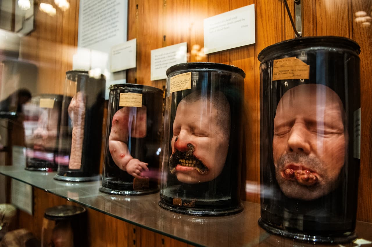 En una velada especial, el museo presentó nuevas formas de “contextualizar” sus restos humanos, sacándolos del anonimato.
<br>
<br>Moldes de cera de pacientes con distintas enfermedades de piel y rostro en la galería principal del Museo Mütter.