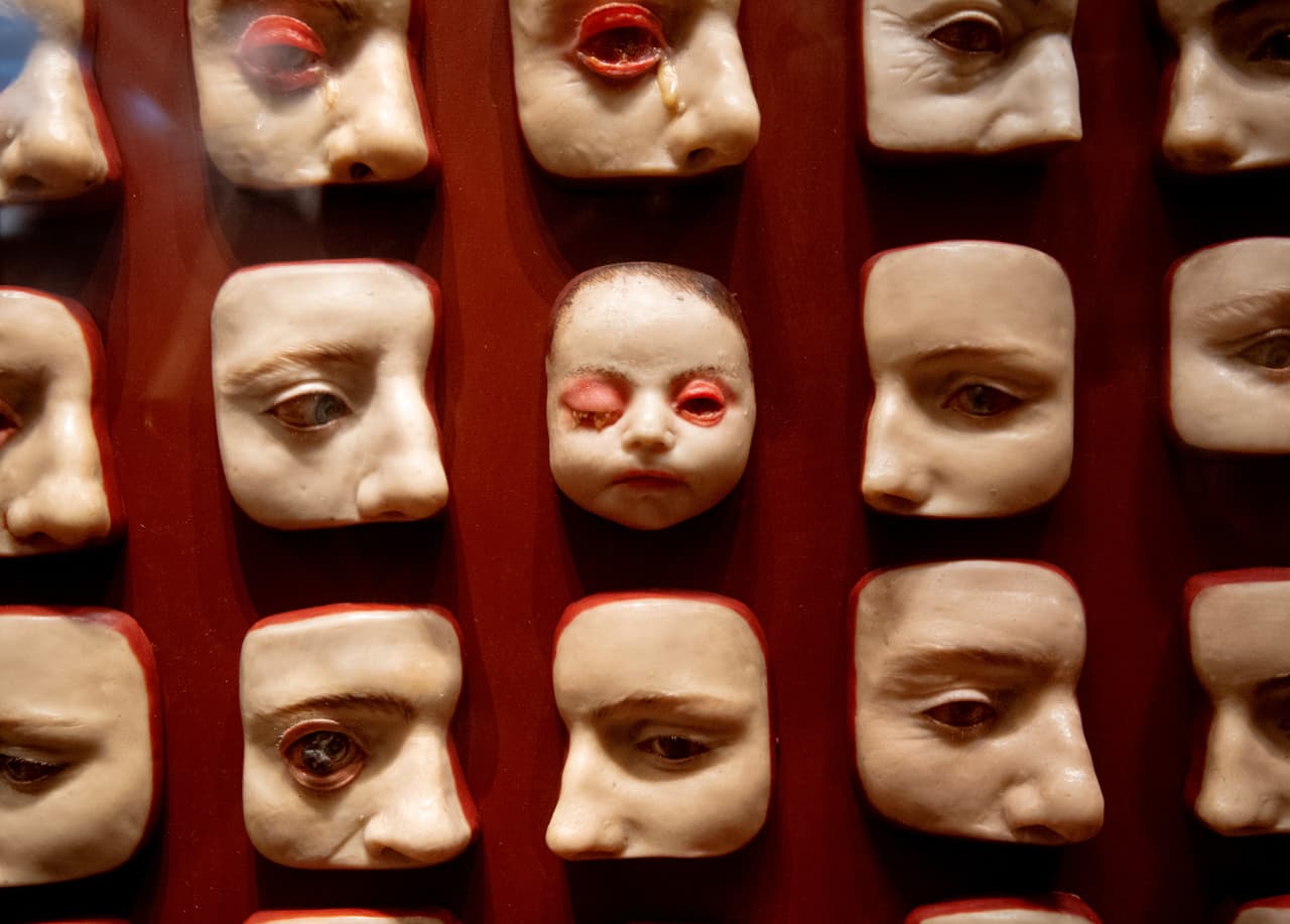 Moldes de cera que representan diversas enfermedades oculares.
<br>
<br>El grupo activista Protect the Mütter reunió más de 35,000 firmas pidiendo la destitución de Quinn, a quien acusaban de alterar la identidad y función del museo con su proyecto para hacer las exhibiciones más "éticas".