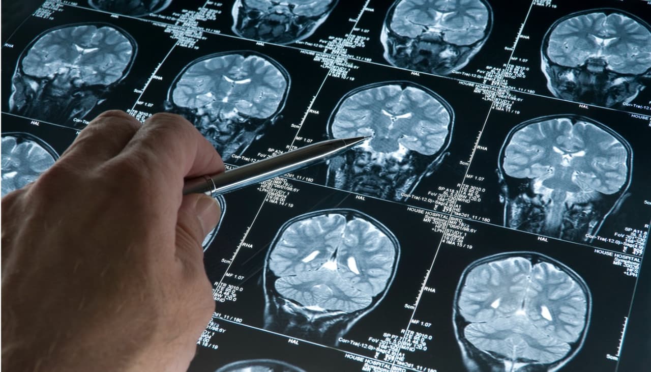 Tips de salud para evitar Alzheimer: Haz estas 6 actividades para fortalecer tu cerebro