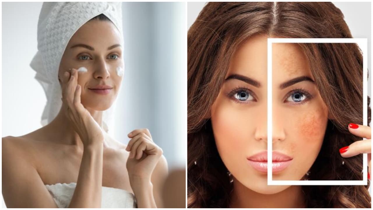 ¿Tienes manchas oscuras en la piel? Podría ser melasma, te decimos cómo tratarlo