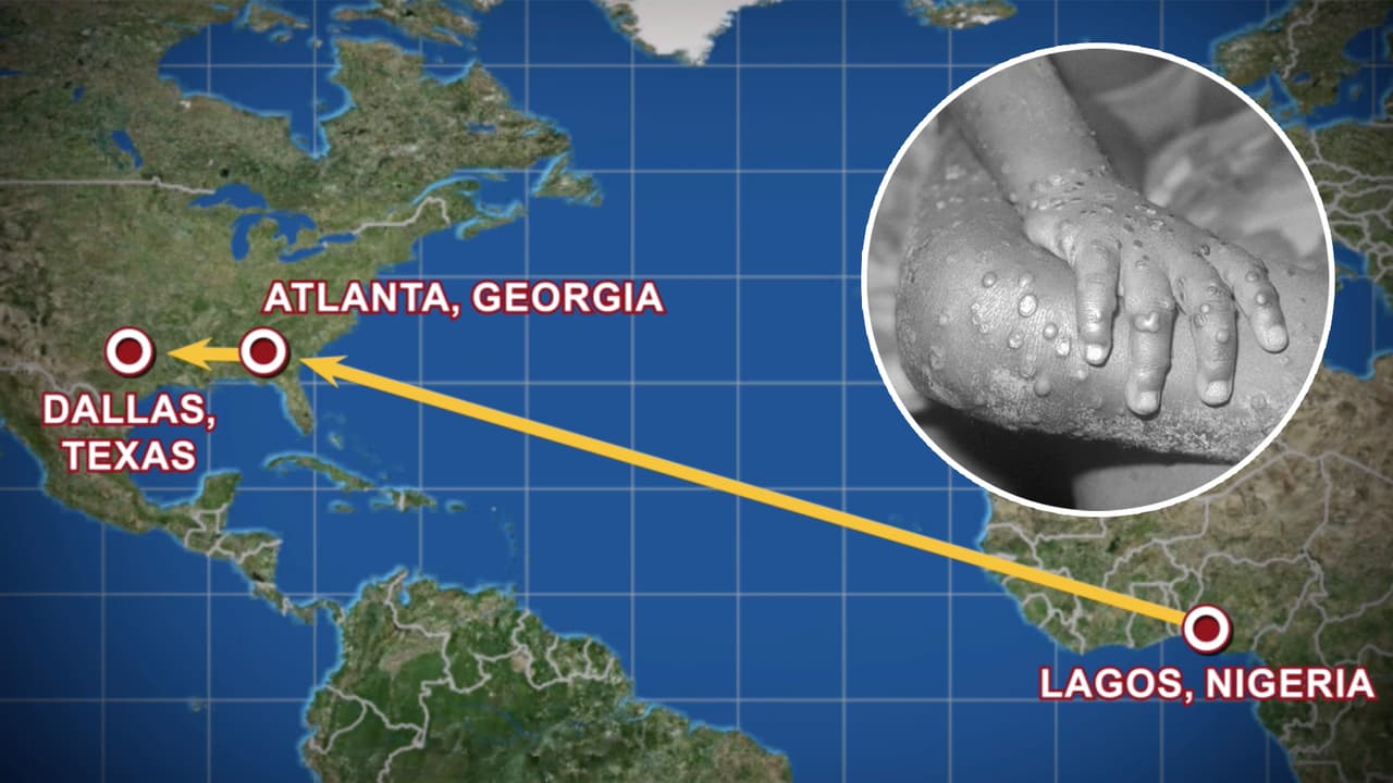De acuerdo con el Departamento de Salud del Condado Dallas, el paciente contagiado se encuentra en condición estable y recientemente había estado de viaje en Nigeria.