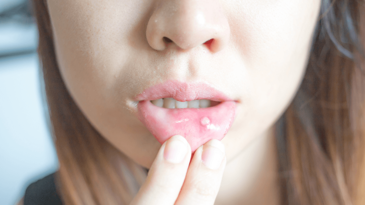 Las ampollas en la boca pueden ser señal de diversas enfermedades, además del herpes