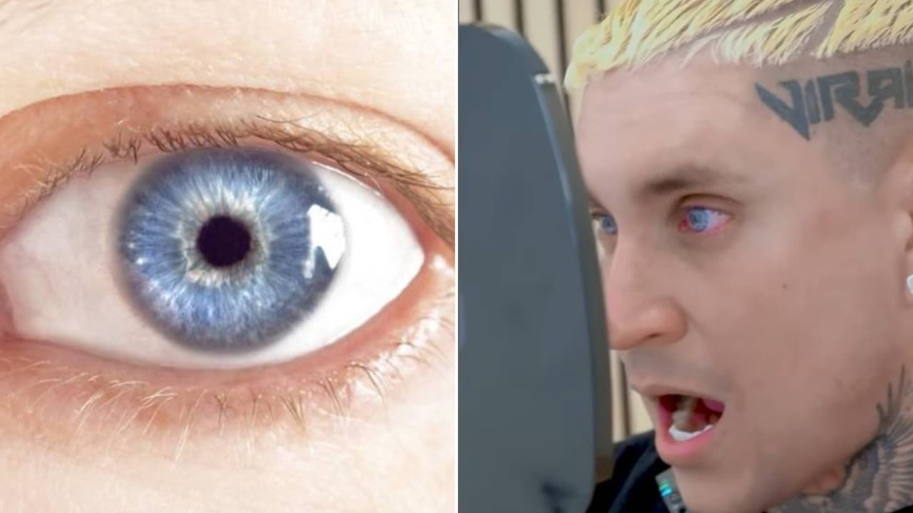 El reguetonero Osmani García cambió el color de sus ojos: ¿cuáles son los riesgos del procedimiento?