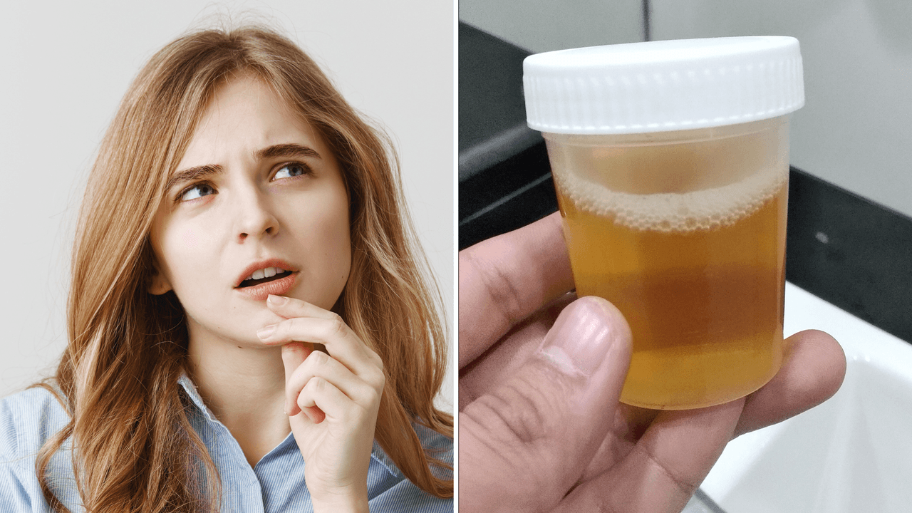 La orina con espuma no es normal y podría ser síntoma de una enfermedad silenciosa