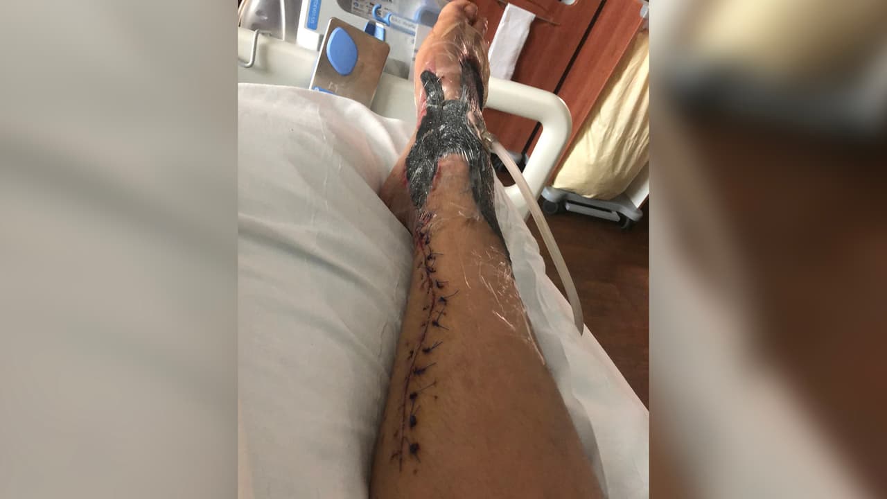 Lou fue enviada al
<a href="https://www.utmbhealth.com/" target="_blank">Centro Médico de la Universidad de Texas en Galveston (UTMB)</a> donde la operaron de emergencia y luego tuvo que ser intervenida cuatro veces más. "Me dijo el doctor que era afortunada de no perder el pie porque la mayoría de estos casos es amputacion" dijo.