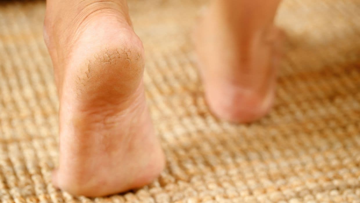 El talón agrietado no solo es piel reseca, puede tener 3 causas mucho más serias: entérate cuáles