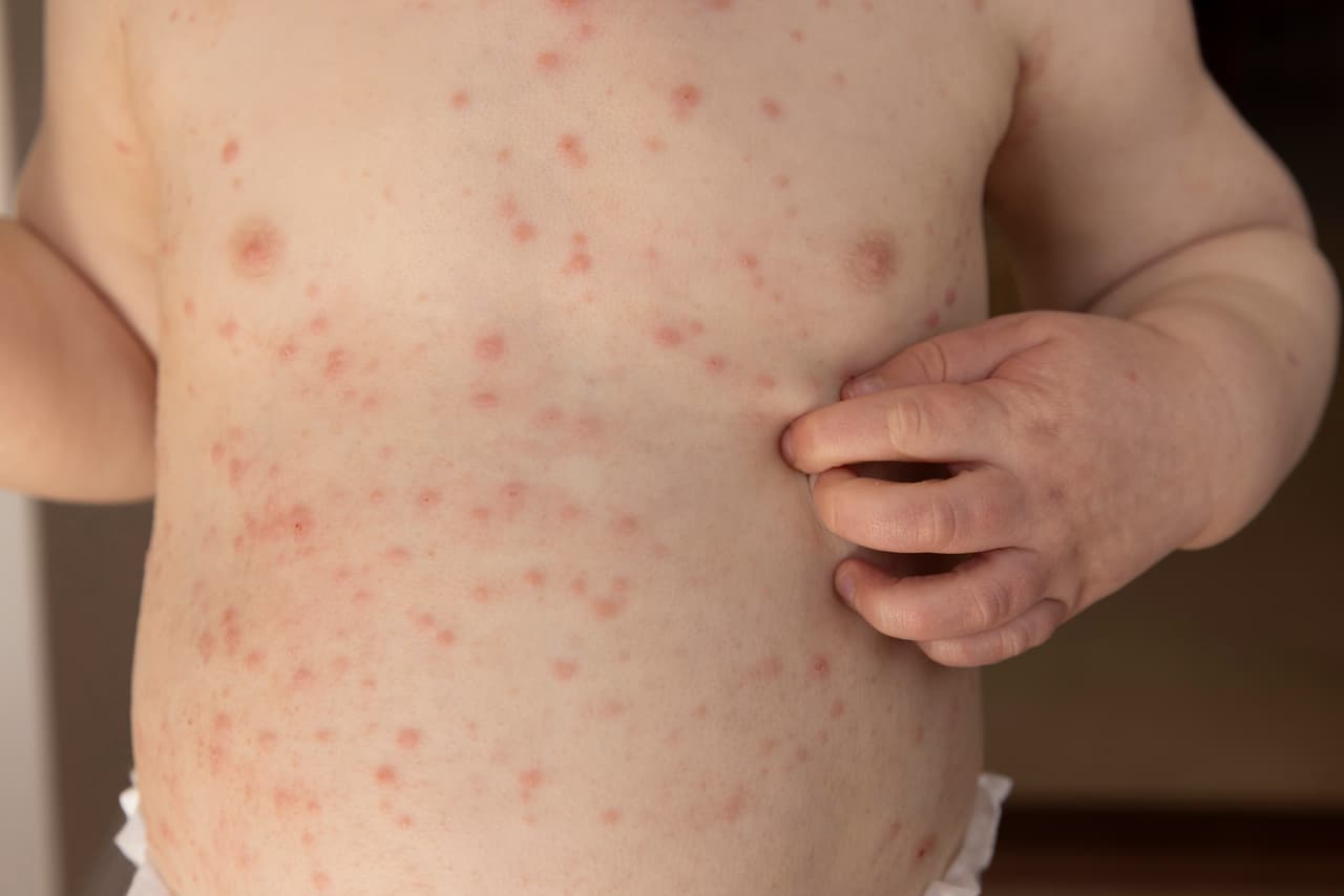 Niño fallece en Los Ángeles por complicación del sarampión contraído antes de vacunarse