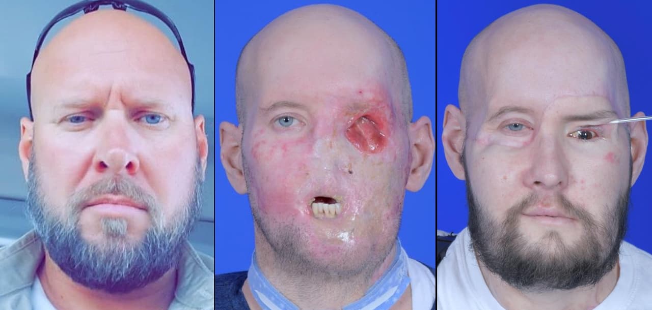 Un hito médico: realizan en Nueva York el primer trasplante de globo ocular del mundo