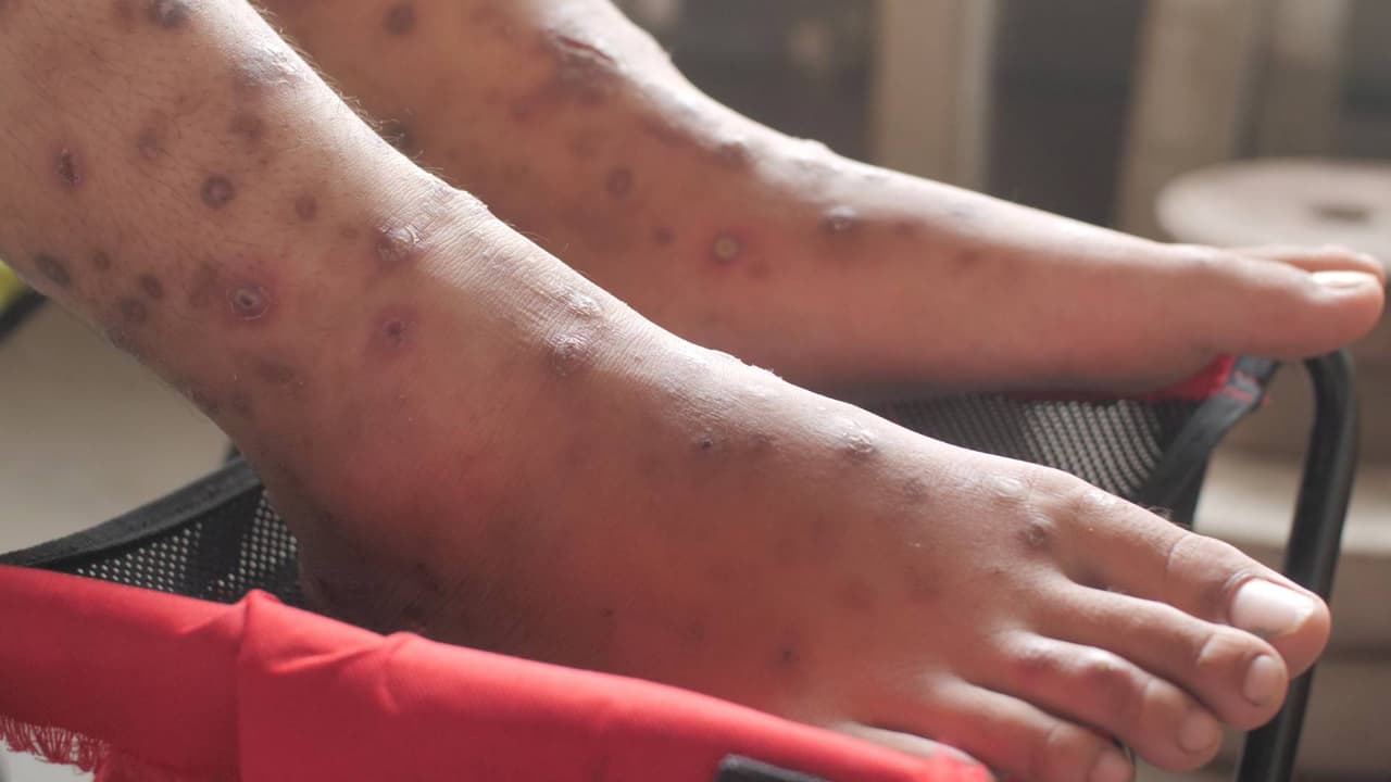 Unos 140 presos fueron puestos en cuarentena por un brote de sarna en la Correccional Estatal de Utah