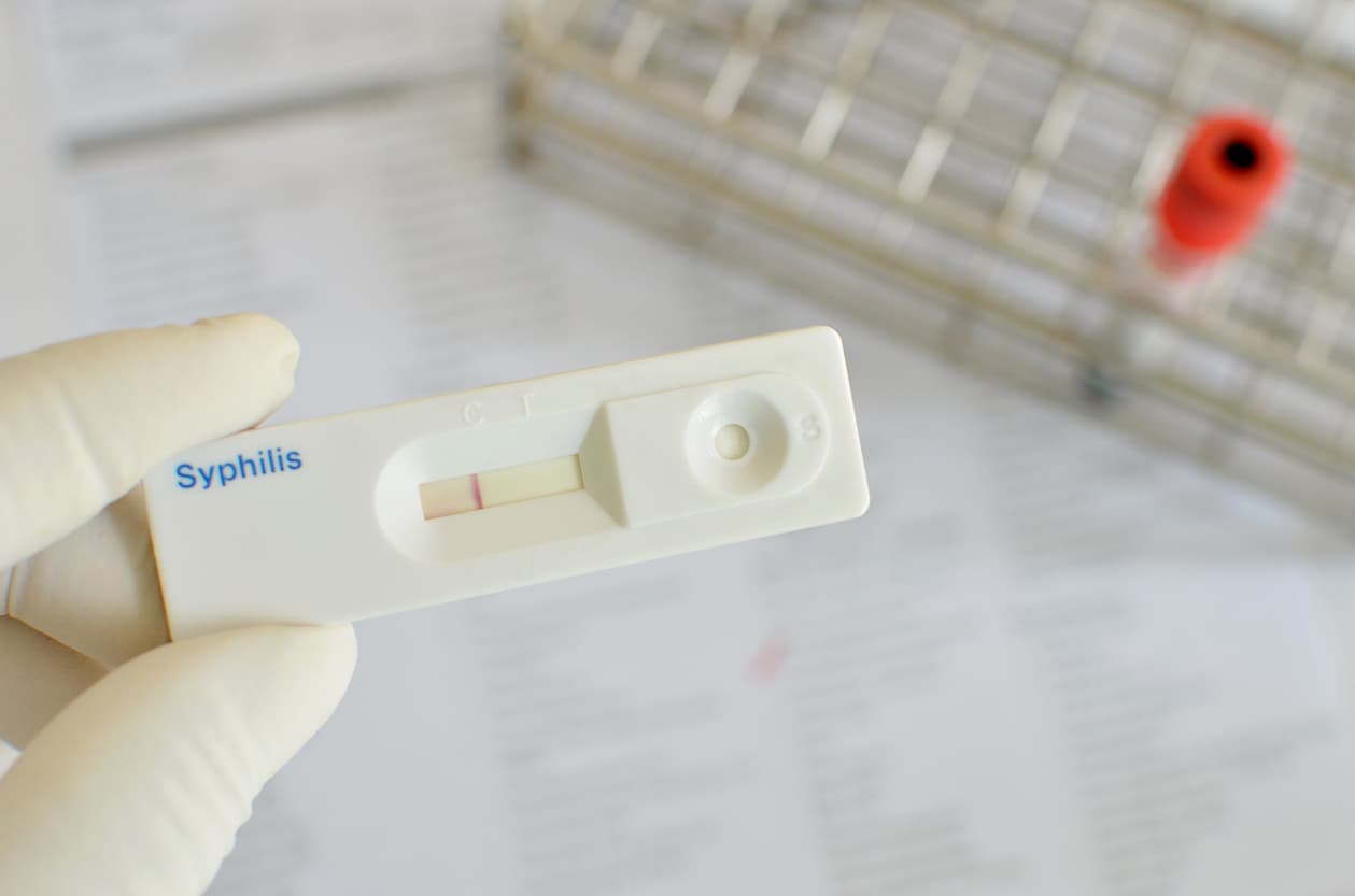 El alarmante aumento de los casos de sífilis en EEUU que no se veía desde la década de 1950
