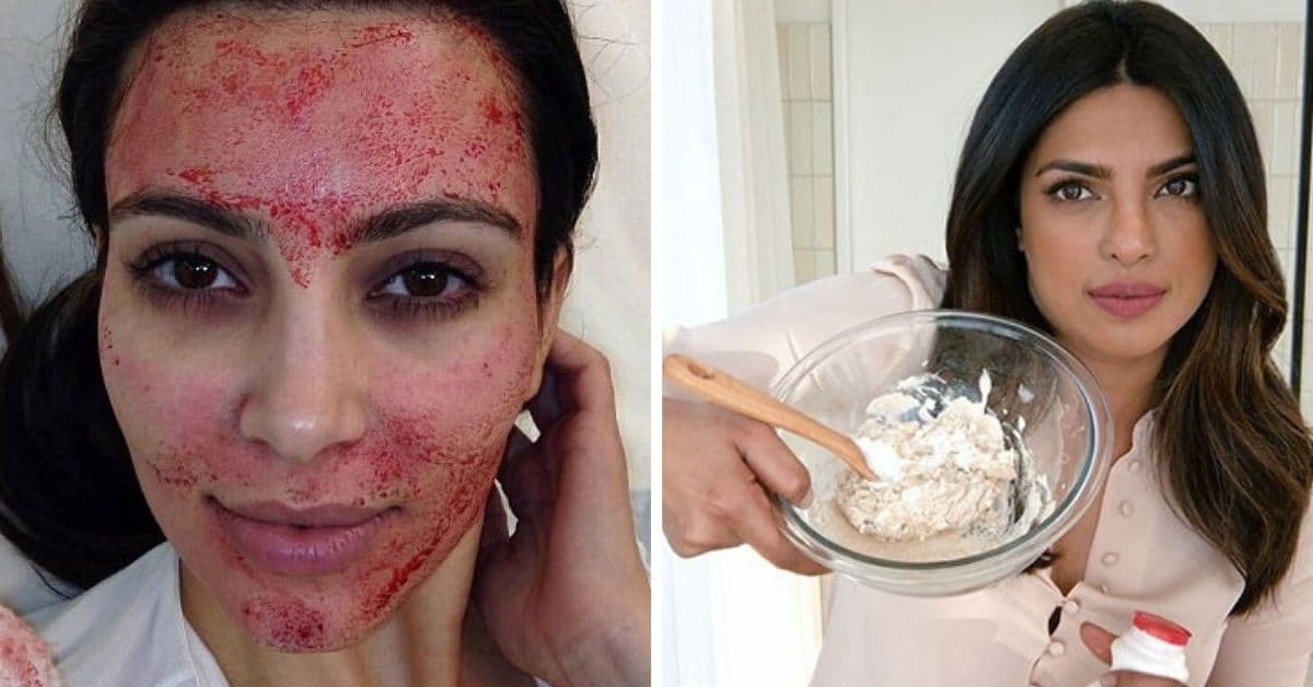 Los tratamientos de belleza más extraños de las famosas: Gwyneth Paltrow usa picaduras de abeja