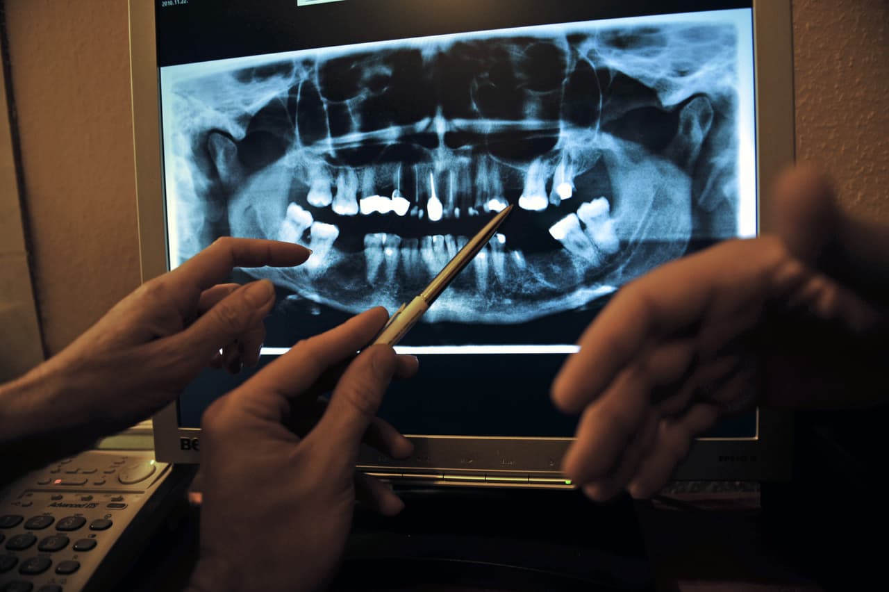 Una enfermedad de las encías muy severa, con dientes muy movibles y difícil de controlar solo con tratamiento dentario, puede indicar que el paciente podría estar sufriendo de diabetes.