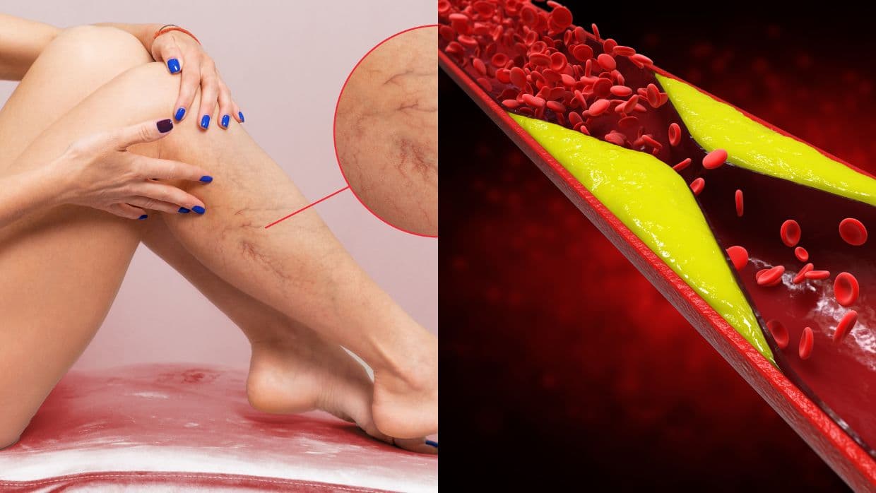 ¡Cuidado! Estas son las señales silenciosas de la trombosis