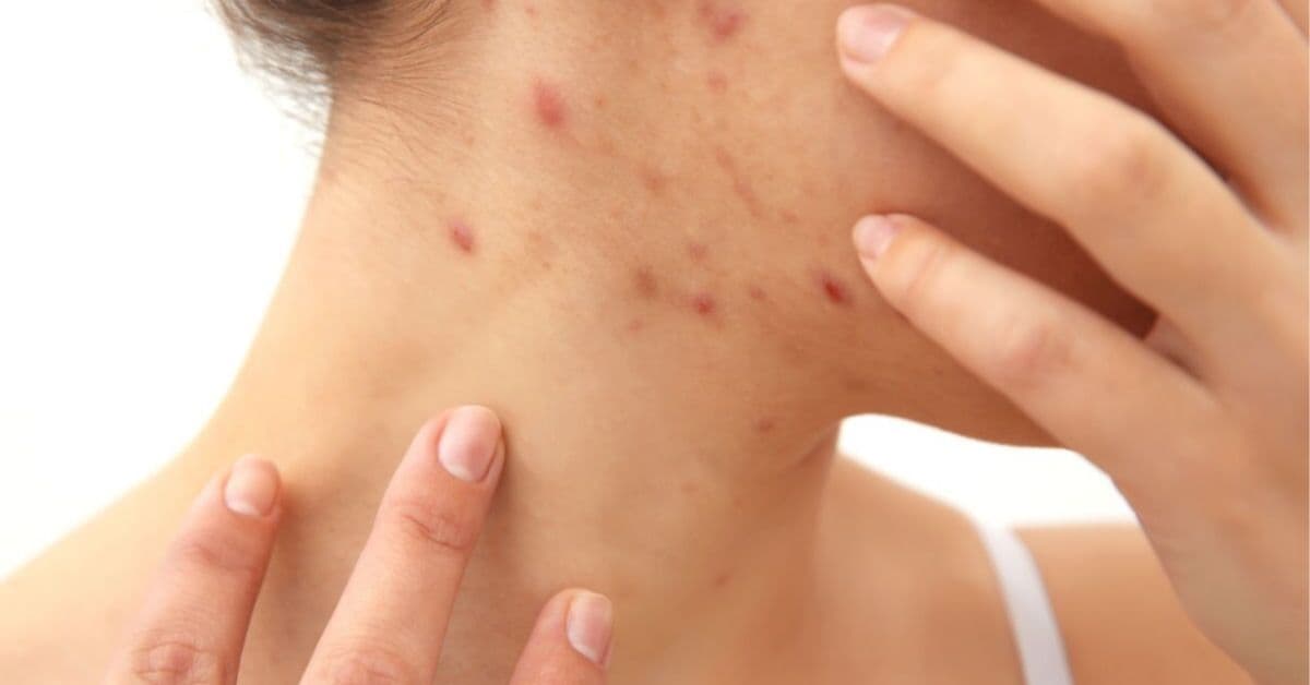 ¿El acné no disminuye? Es posible que el enemigo sea otro y más fácil de eliminar