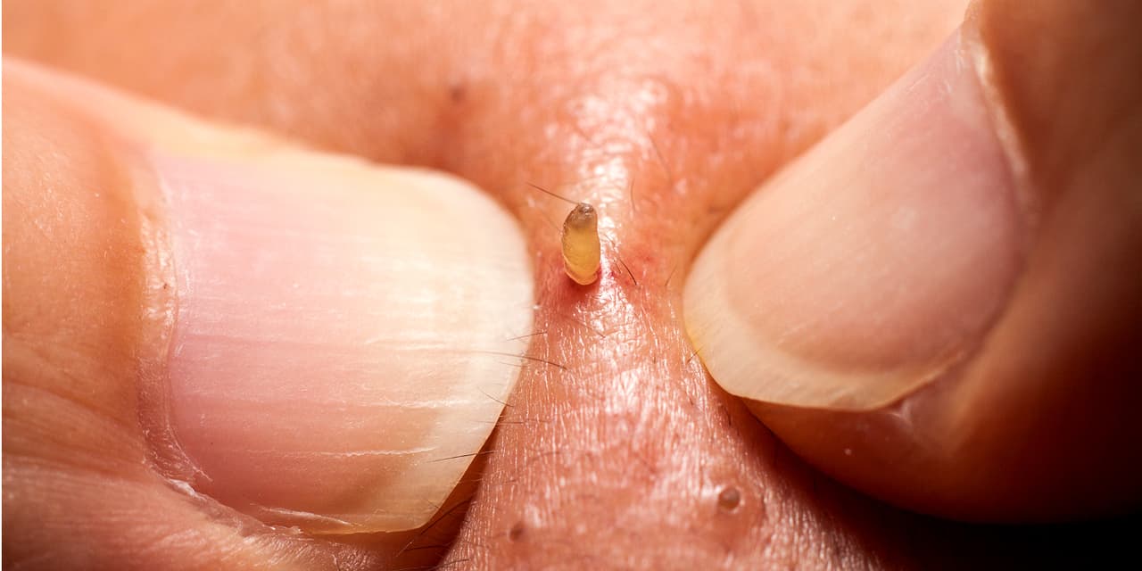 Cinco hábitos que están empeorando tu acné y ni siquiera te habías dado cuenta