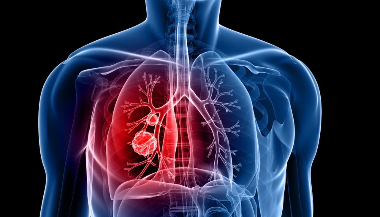 El cáncer de pulmón podrá detectarse hasta 4 años antes de que aparezcan los síntomas