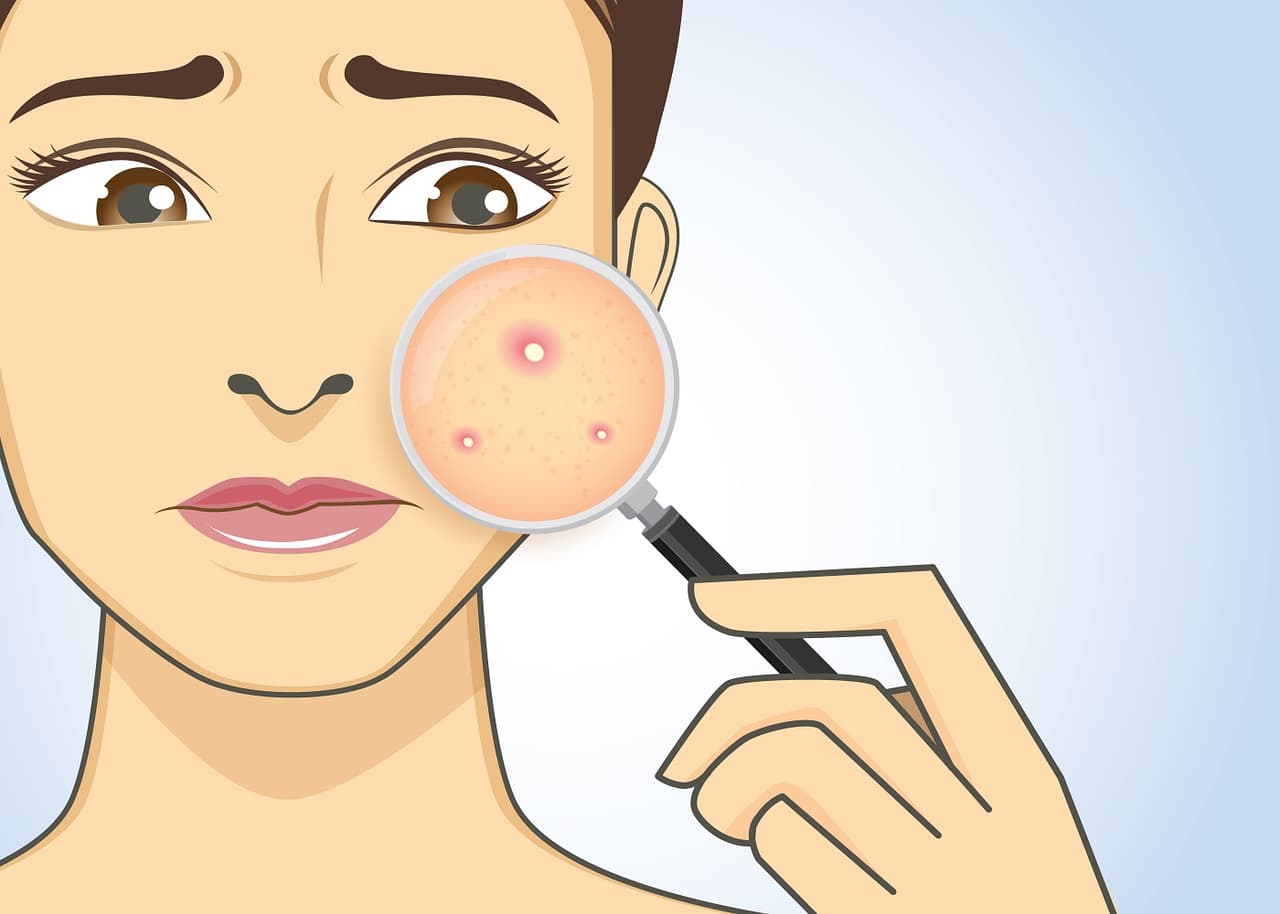 Las espinillas en cada lugar del cuerpo quieren decirte una cosa sobre tu salud