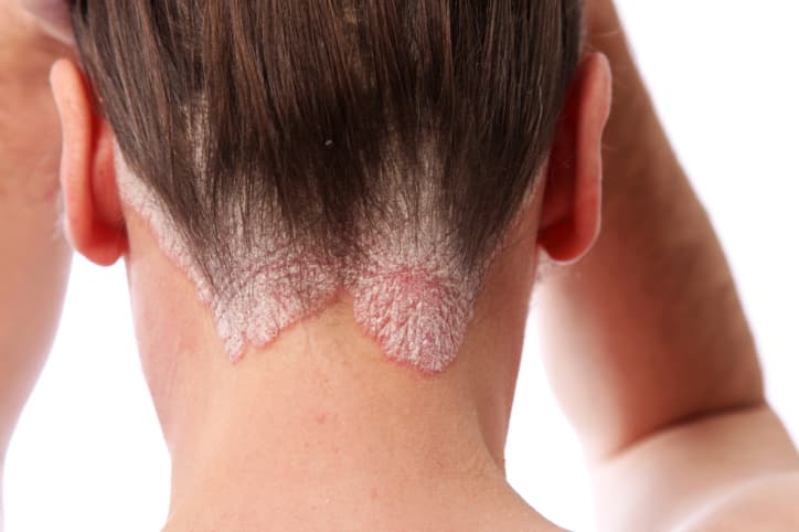 Cómo tratar la psoriasis del cuero cabelludo
