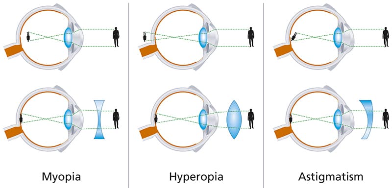 ¿Sabes la diferencia entre astigmatismo y miopía? Así puedes detectarlos
