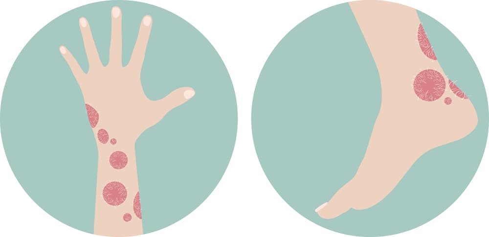 Si tienes psoriasis, aléjate de estos alimentos que solo la empeoran