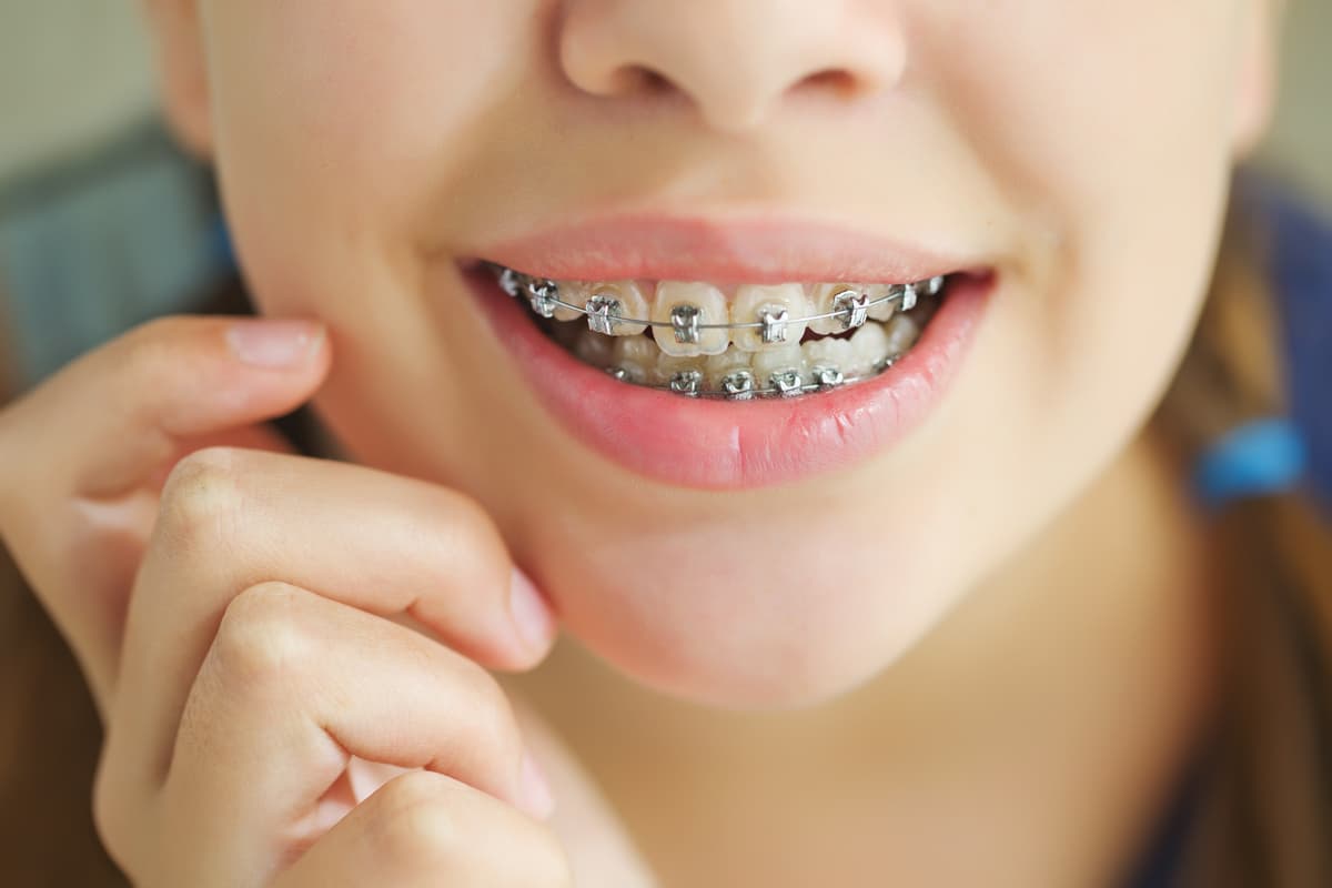 Si tuviste brackets de adolescente podrías tener encías retraídas, conoce la enfermedad