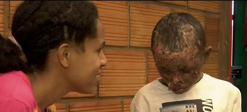 Sonia pide ayuda para poder seguir con el tratamiento en Colombia, con la mente siempre en un pronóstico fatalista que una doctora venezolana le dijo hace un tiempo.
<b>"Me aseguró que los <a href="https://www.univision.com/temas/menores-de-edad">niños</a> con esta enfermedad no vivían más de 10 años (...) cada día que pasa es una angustía", dice. </b>