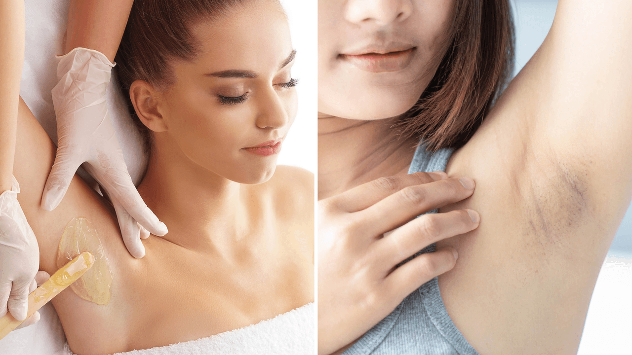 La depilación puede causarte manchas en la piel: tips para desvanecerlas y evitarlas