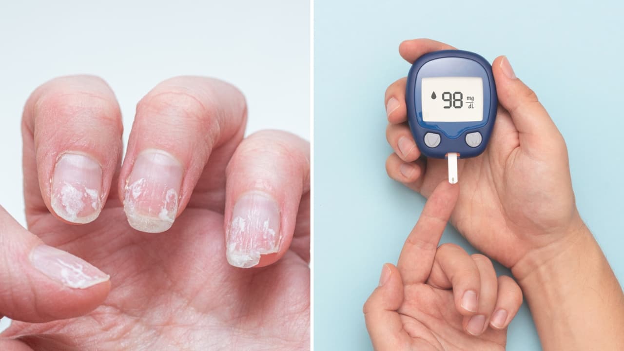 Tener hundimientos en las uñas puede ser señal de diabetes y otros problemas de salud