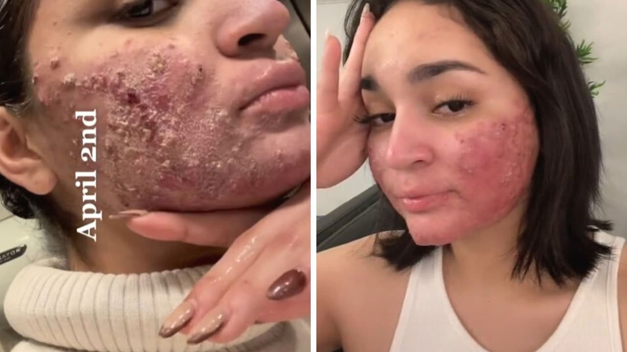 Joven con acné severo muestra su transformación tras someterse a tratamiento: video cautiva a redes