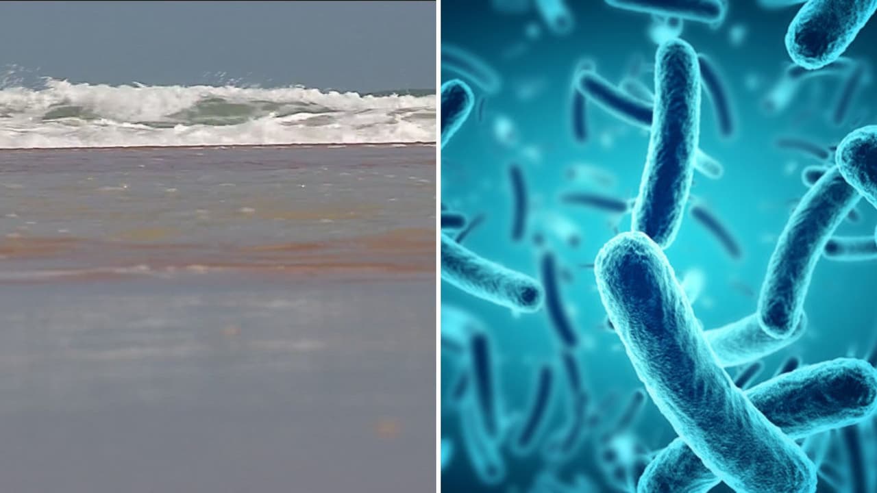 Casos de bacteria come carne en Florida: ¿dónde hay mayor riesgo de contagiarse?