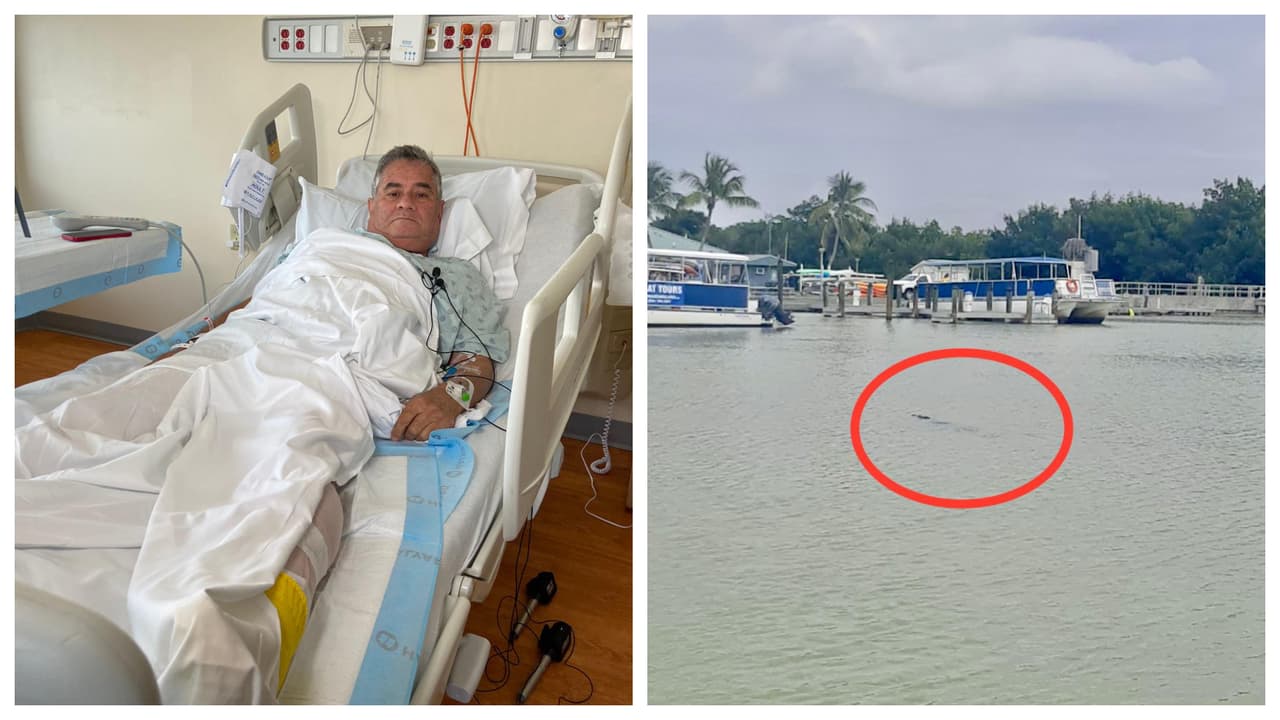 “Traté de abrirlo": hombre relata cómo sobrevivió a un ataque de cocodrilo en el sur de Florida