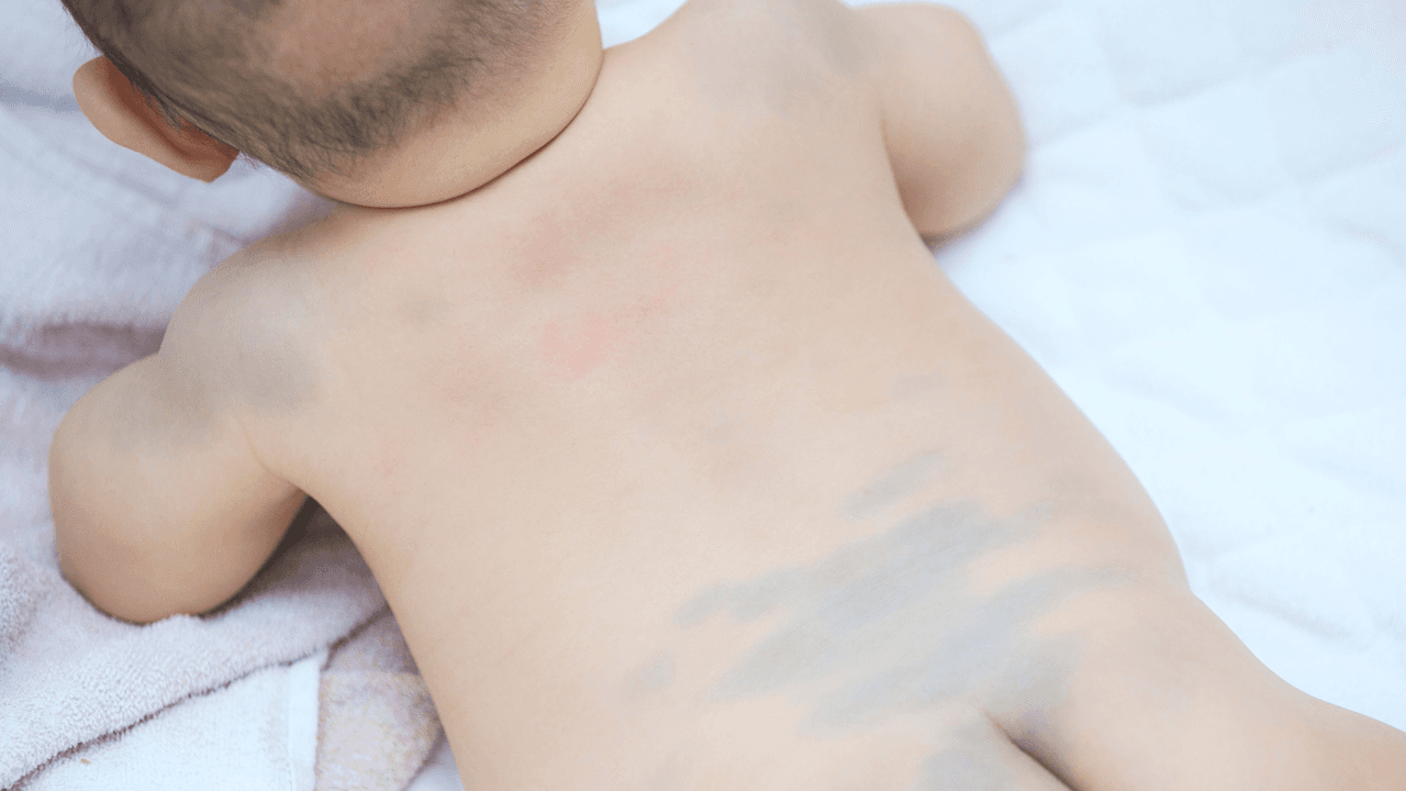 ¿Qué es esa 'mancha' que aparece en la espalda y pompis de algunos bebés?