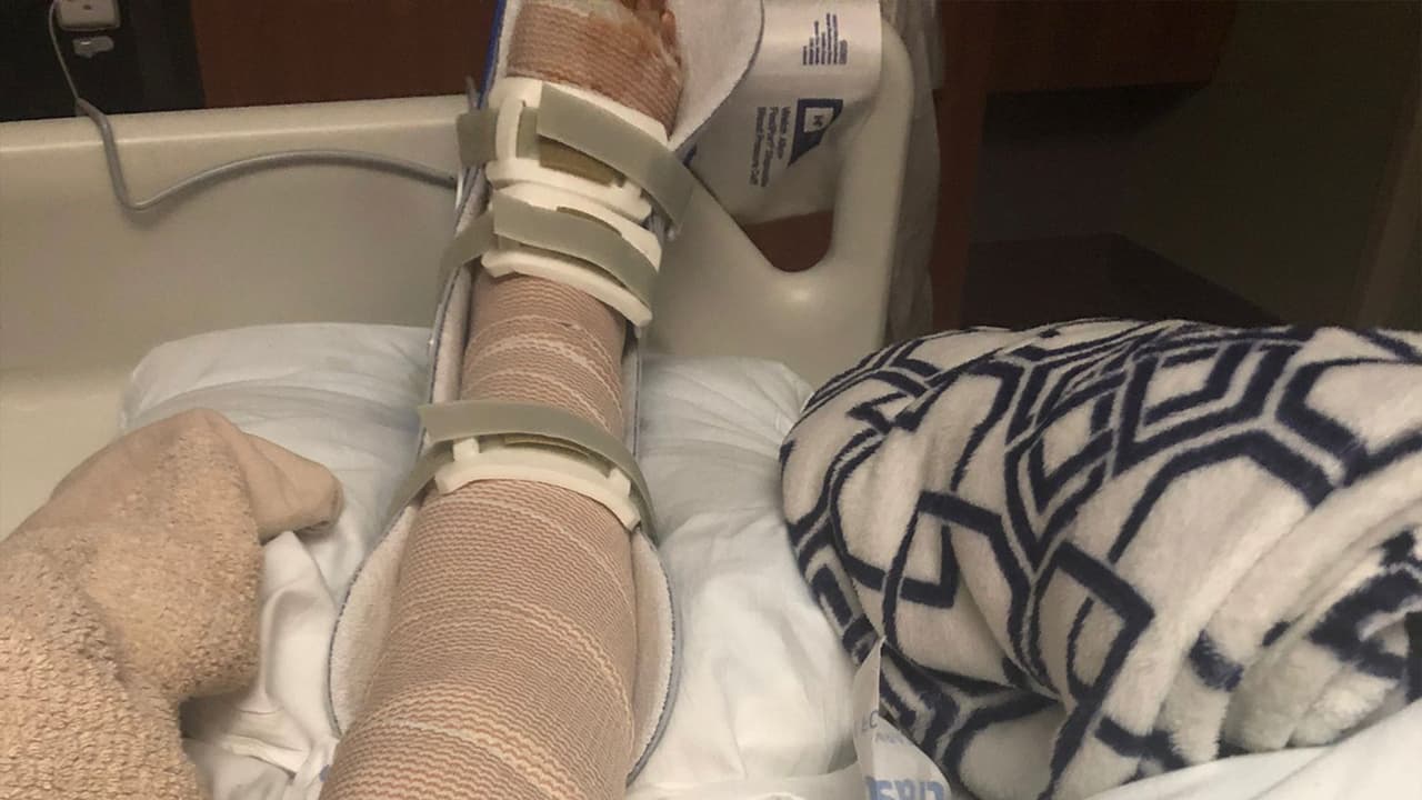 "Por dentro es un dolor muscular intenso y por fuera es un ardor tremendo. Se siente que te quemen en vida" le dijo esta madre de cuatro hijos a
<a href="https://www.univision.com/local/houston-kxln/">Univision 45</a>.